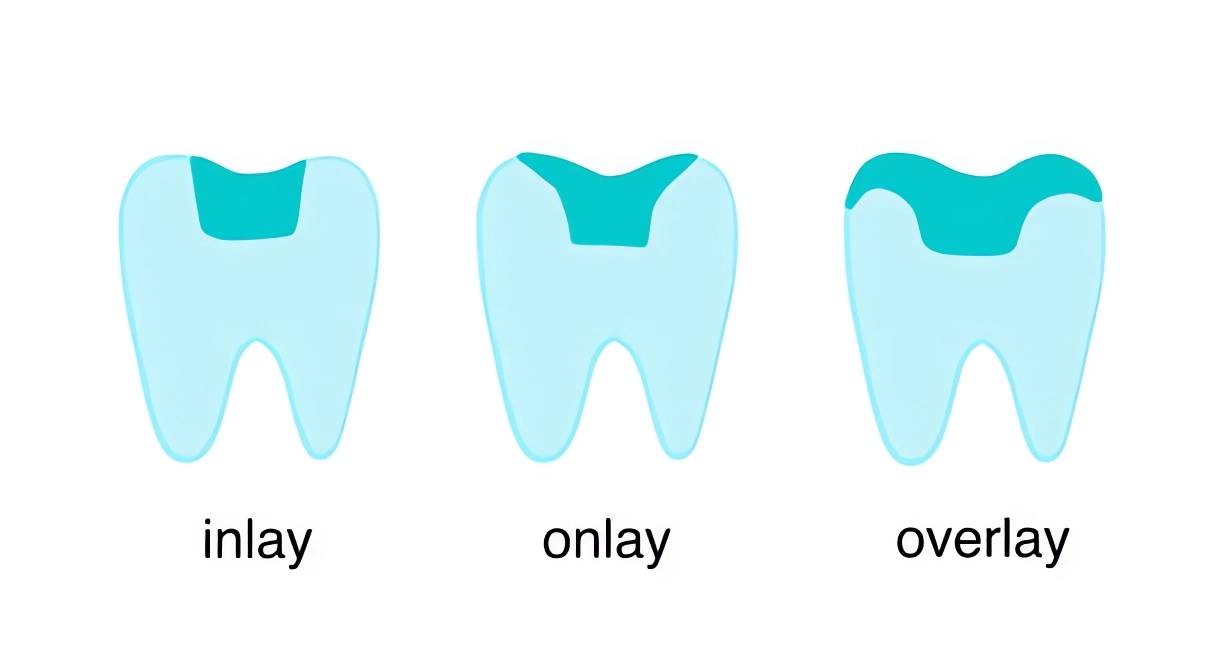 Inlay, onlay, overlay